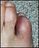 Broken Toe?